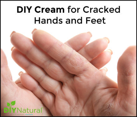 Cream for Cracked Hands and Feet