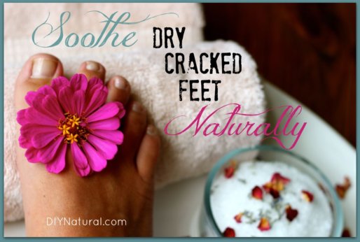 Dry Cracked Feet Homemade Foot Cream