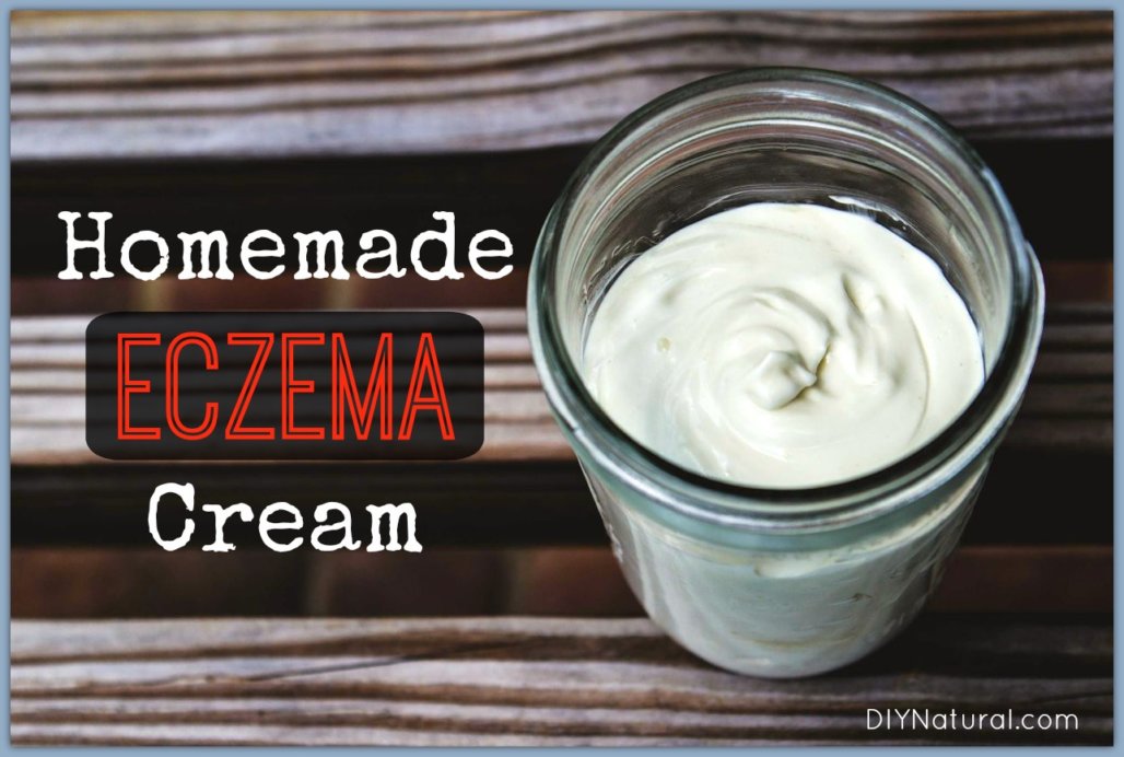 Homemade Eczema Cream: A Natural