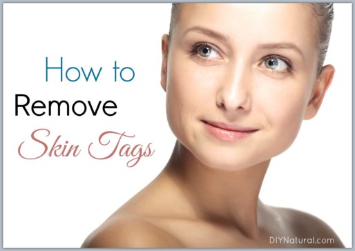 How To Remove Skin Tags