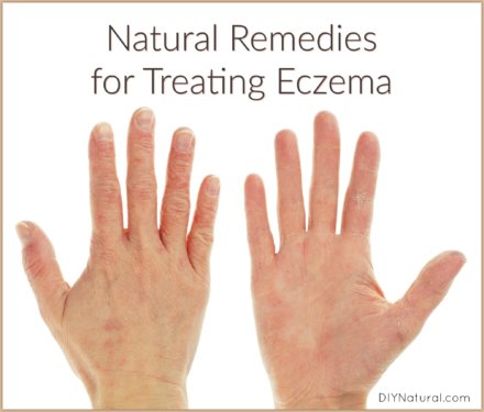 Natural Remedies for Eczema