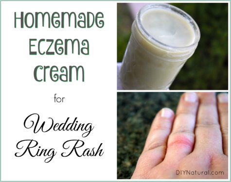 Wedding Ring Rash Homemade Eczema Cream